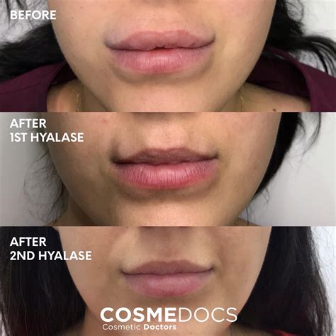 How To Remove Lip Filler Lumps at Grace Brentnall blog