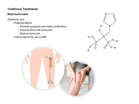 Myelofibrosis_Treatment