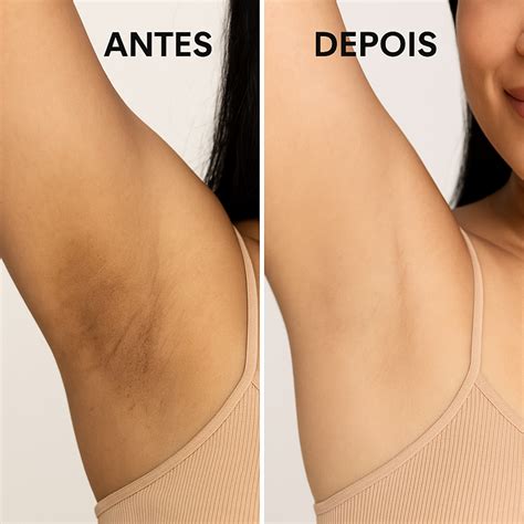 Clareador Virilha Antes E Depois