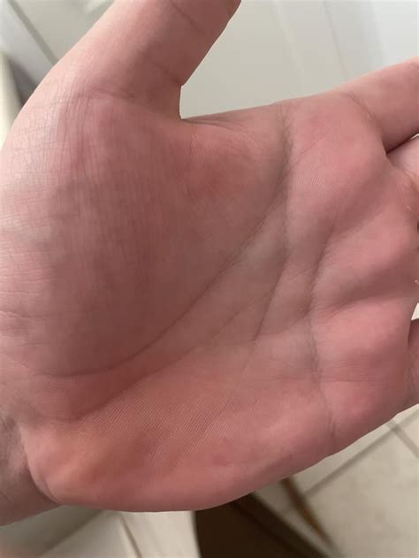 Red spots on palms : r/Dermatology