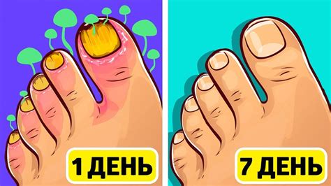 ГРИБОК НОГТЕЙ ИСЧЕЗНЕТ НАВСЕГДА С ПОМОЩЬЮ ЭТОГО ДОМАШНЕГО СРЕДСТВА ...