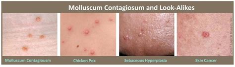 molluscum contagiosum face