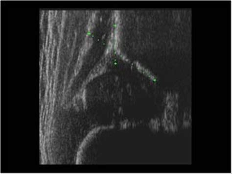 musculoskeletal joints  tendons  hip groin  buttock case