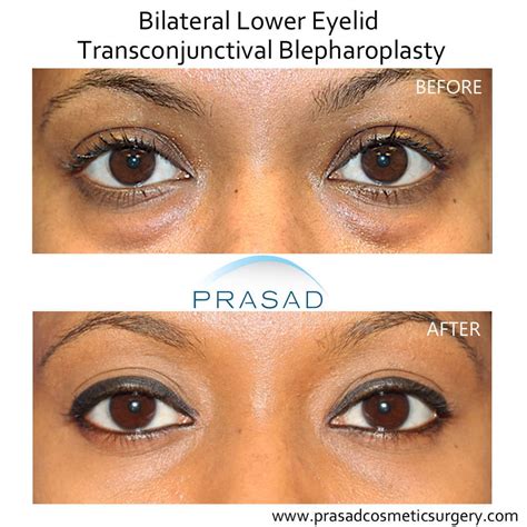 Lower Blepharoplasty Before and After Photos