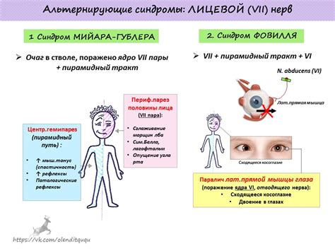 Альтернирующие синдромы Мийара-Гублера и Фовилля - Форум Здоровья