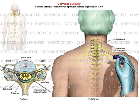 level   posterior cervical interlaminar epidural steroid inject