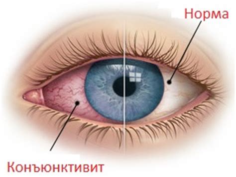 Коньюктивит: симптомы и лечение, фото, профилактика