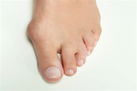 5 Home Remedies to Get Rid of Bunion Pain Fast - Step To Health