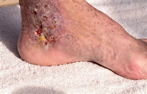 cellulitis   worry    symptoms complete care