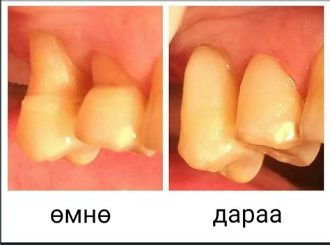 ШААНТАГ ХЭЛБЭРИЙН СОГОГ ГЭЖ... - Цэгц Дент шүдний эмнэлэг | Facebook