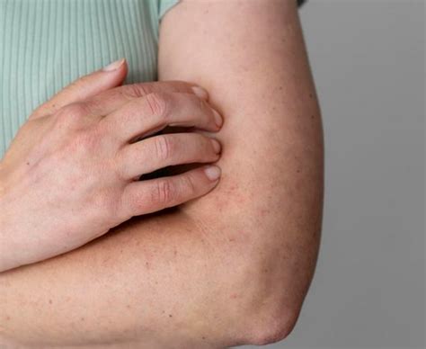 ciri ciri penyakit eksim  perlu diketahui terastimur