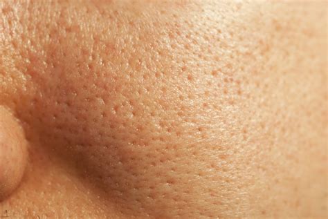 Dilated Pores - VitalSkin Dermatology