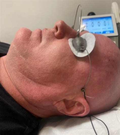 BBL Treatments | Laser Clinics New Zealand