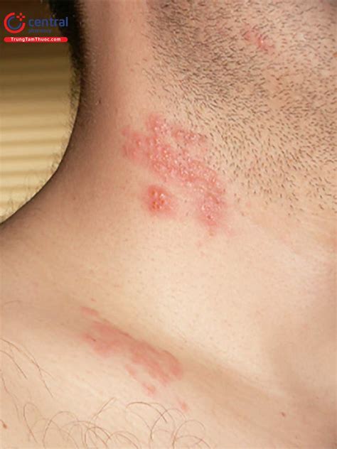 Bệnh zona thần kinh (giời leo): nguyên nhân, cách chẩn đoán và phác đồ ...