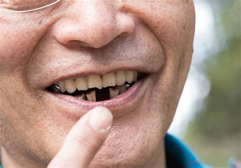 Can Dark Brown Stains Be Removed From Teeth? (Professional Whitening ...