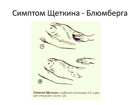 Өткір холецистит - презентация онлайн