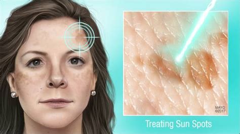 Mayo Clinic Q and A: Treating sunspots - Mayo Clinic News Network