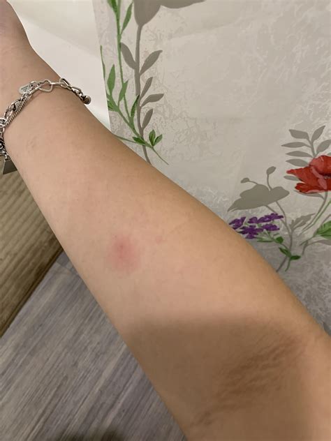 Bad Tb Test Looks Like