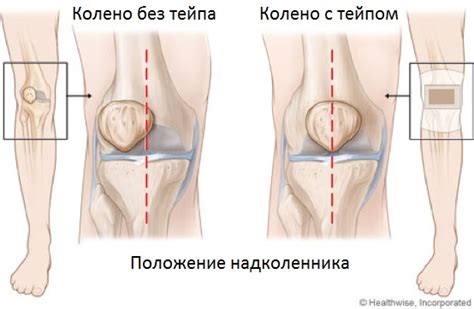 Тейпирование надколенника - KinesioPro