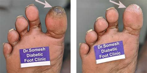 Gangrene On The Foot Causes Symptoms Risks And How To Treat