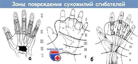 Диагностика повреждений сухожилий кисти и их классификация