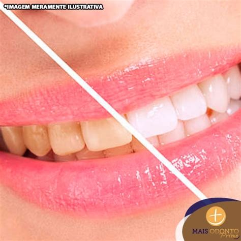 O Que É Clareamento De Dente Desvitalizado