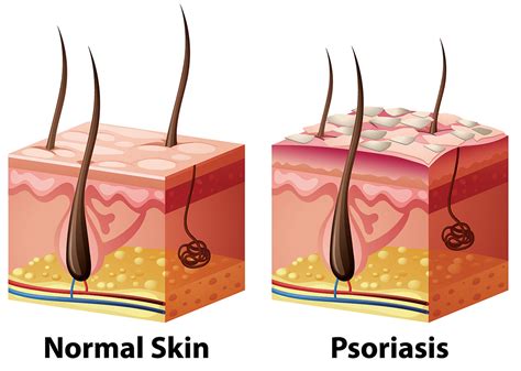 understanding psoriasis      manage  klse screener