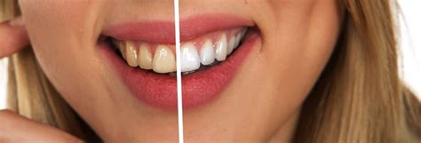 DENTAL FLUOROSIS | Lavanya Dental Clinic