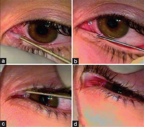 Lacrimal Punctum Swollen