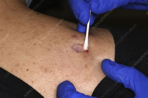 shave biopsy procedure stock image  science photo library