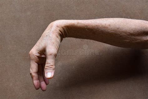 Radial Nerve Injury or Wrist Drop Stock Image - Image of flex, fingers ...