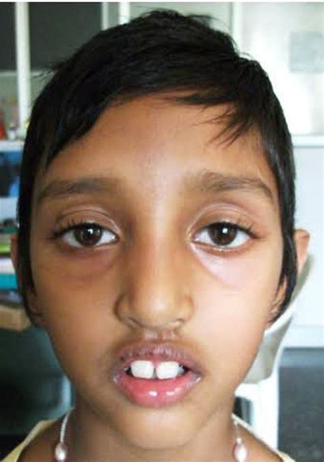 Adenoid Face Before And After