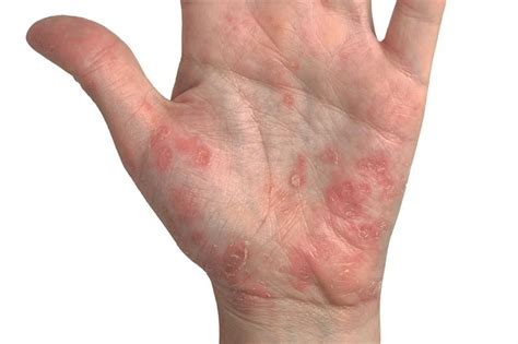 New treatment effective for severe psoriasis
