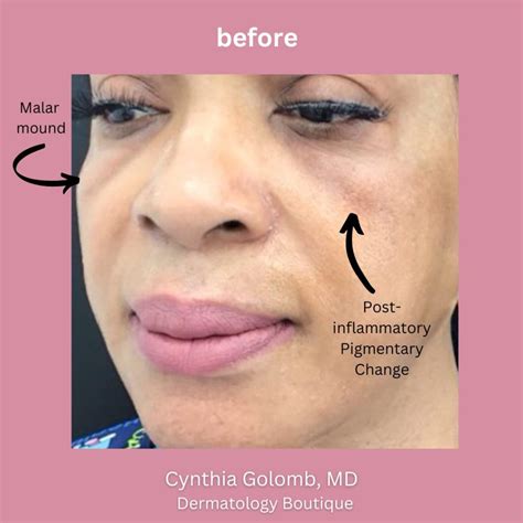 malar mounds  festoons     rid   cynthia