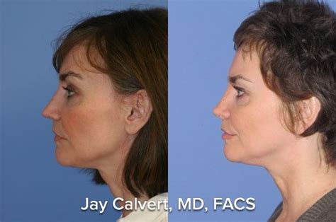 dr jay calvert experience  rib graft revision follow  dr jay