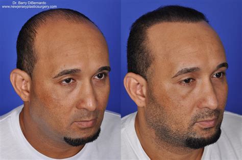 medical hair restoration  sara gardner blog