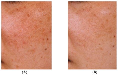Mechanism of Action of Topical Tranexamic Acid in the Treatment of