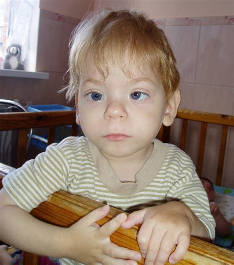 fetal alcohol syndrome face adult 1