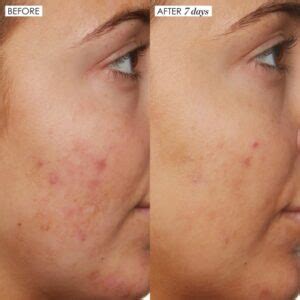 Niacinamida La Roche Antes E Depois - Niacinamida – 6 benefícios, como usar + antes e depois!
