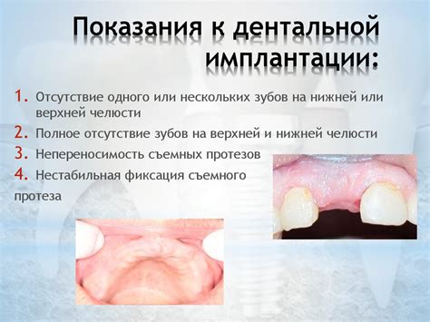 Остеопороз и имплантация - презентация онлайн