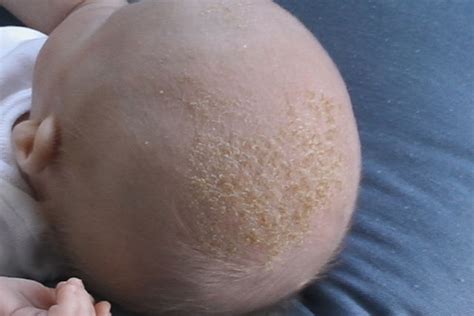 Pele Amarelada Do Bebe