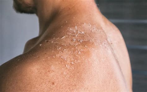 30 Facts About Skin Allergies - Facts.net