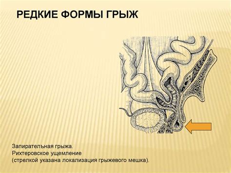 Грыжи живота - презентация онлайн