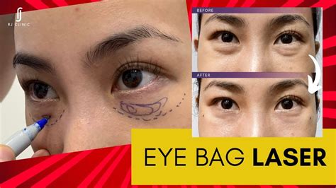 procedure     eye bags  thomas gabaldon blog