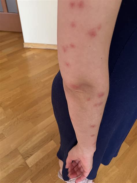 How To Get Rid Of Bed Bug Bites Don't Let The Bed Bugs Bite: What To