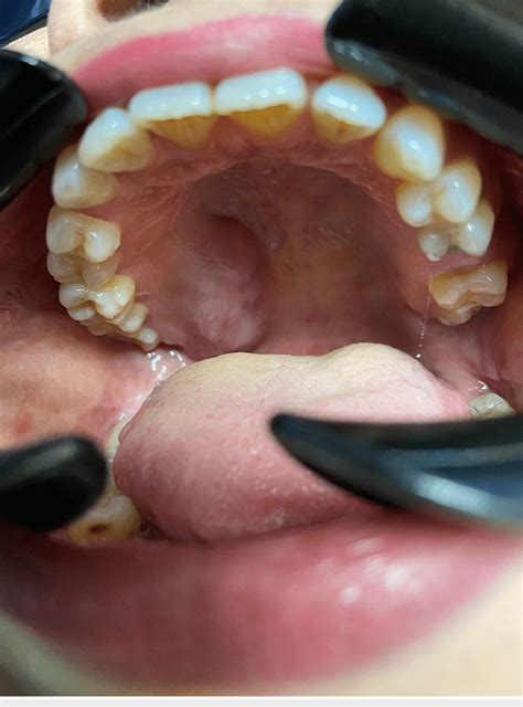 Soft to firm consistency of swelling at the hard and soft palate ...