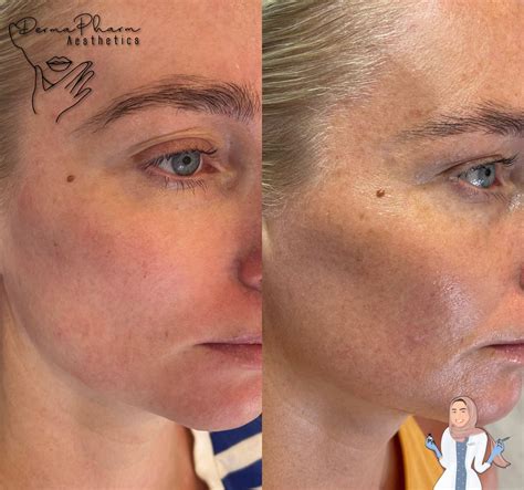 Seventy Hyal Skin Booster - DermaPharm Aesthetics