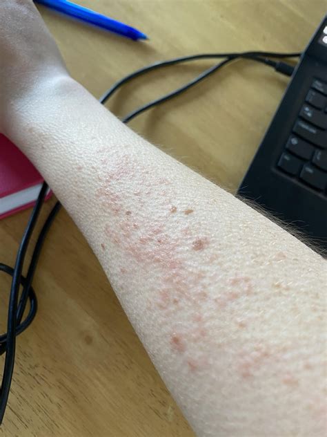 Out of control rash on arm : r/DermatologyQuestions