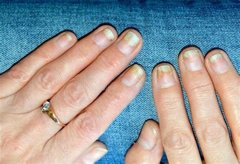Fungal Nail Infection, Onycholysis after Shellac or Gel-varnish Stock ...