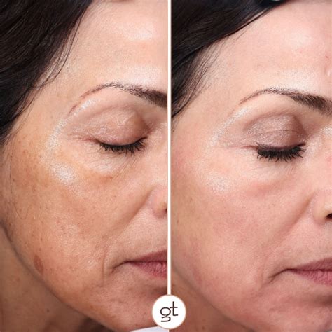 Before and After Gallery Halo Laser - Revolutionary Skin Renewal